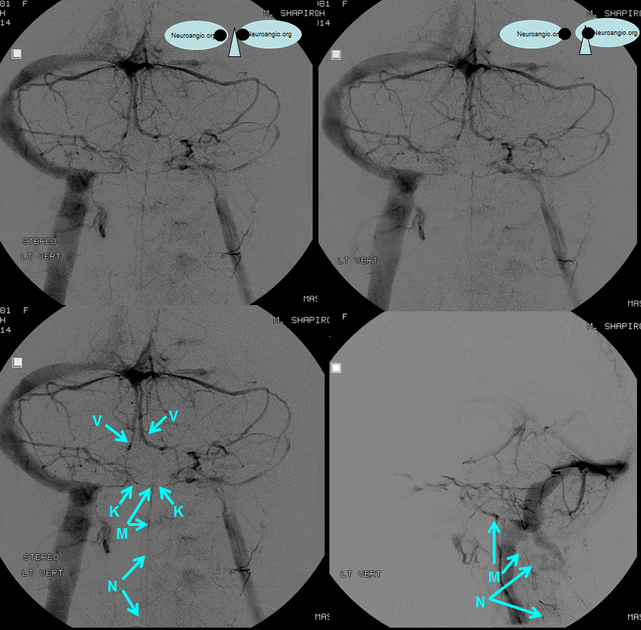 http://www.neuroangio.org/wp-content/uploads/Venous/Posterior_Fossa_Veins/V_verimain_veins_injection_factor.png