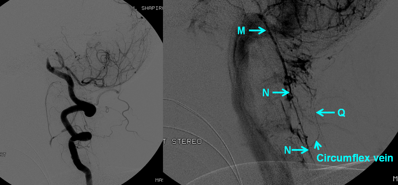 http://www.neuroangio.org/wp-content/uploads/Venous/Posterior_Fossa_Veins/V_anterior_spinal_vein_basilar_occlusion_1.png