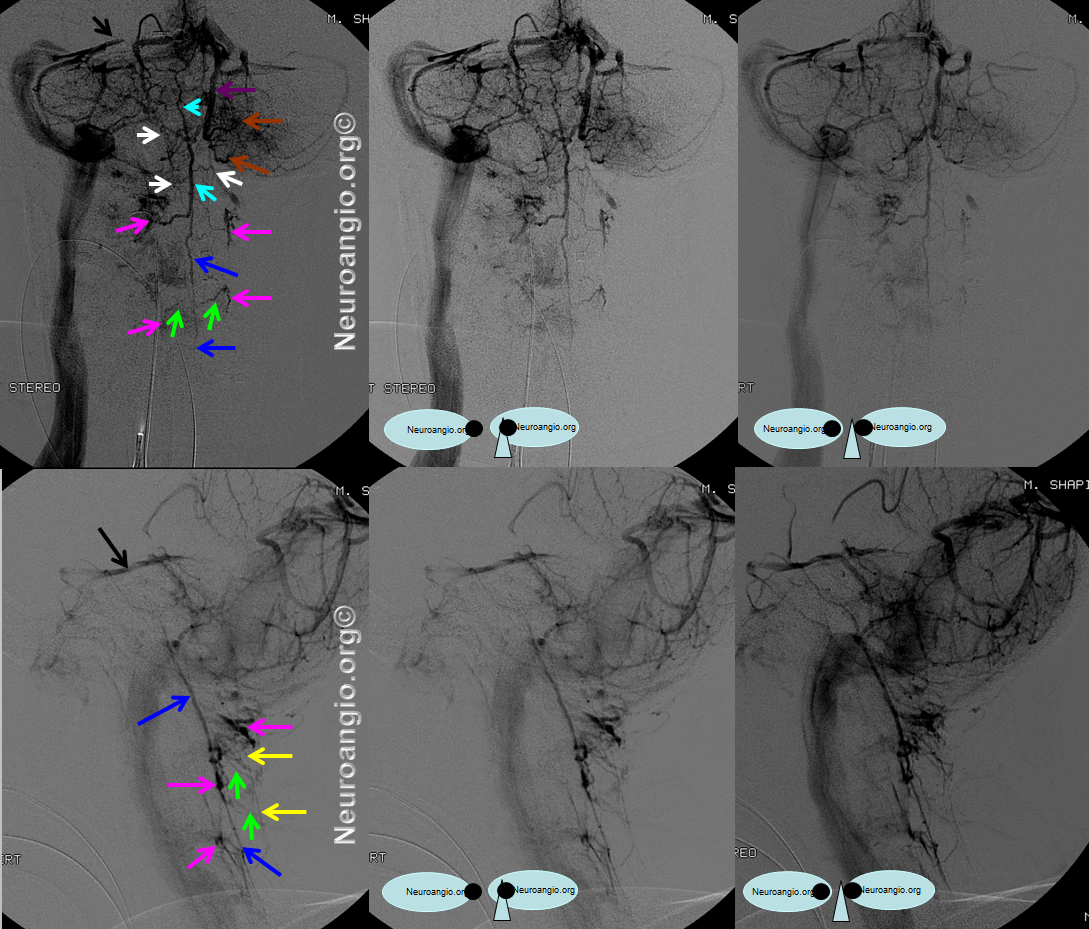 http://www.neuroangio.org/wp-content/uploads/Venous/Posterior_Fossa_Veins/V_anterior_spinal_vein_basilar_occlusion_2.png