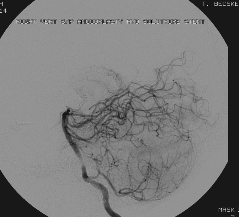 http://www.neuroangio.org/wp-content/uploads/Venous/Posterior_Fossa_Veins/V_anterior_spinal_vein_basilar_occlusion_3.png