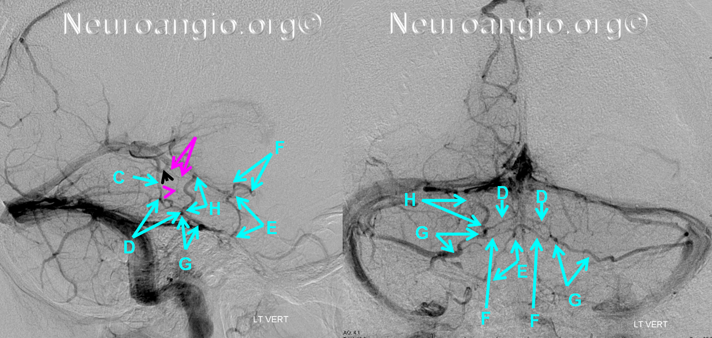 http://www.neuroangio.org/wp-content/uploads/Venous/Posterior_Fossa_Veins/V_balanced_brainstem_brachial_tectal.png