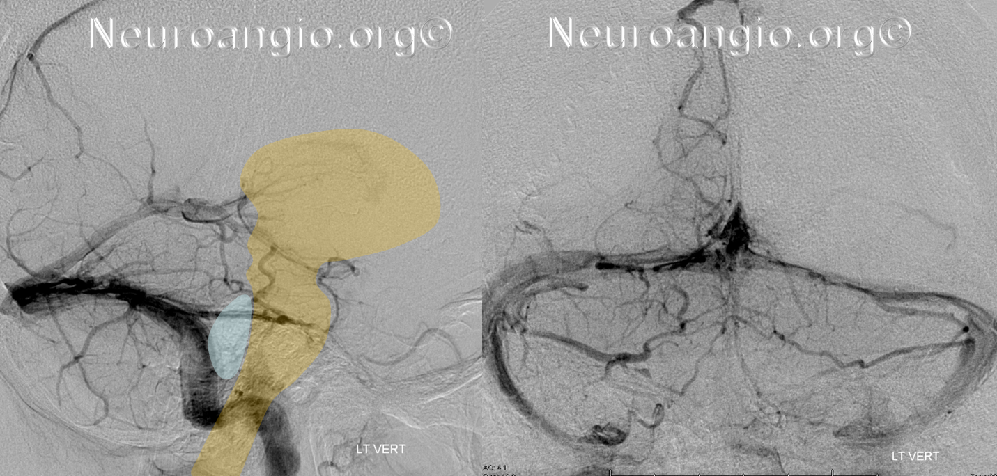 V_balanced_brainstem_brachial_tectal_no_labels.png