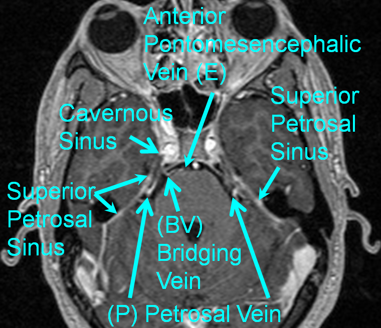 http://www.neuroangio.org/wp-content/uploads/Venous/Posterior_Fossa_Veins/V_bridging_vein_MRI_Petrosal_homolog.png