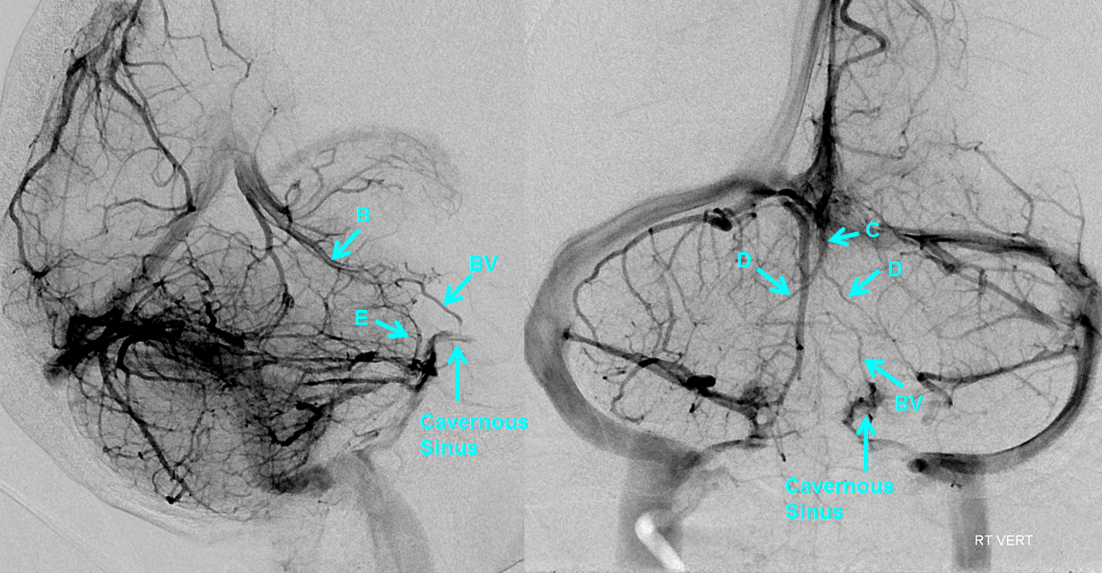 http://www.neuroangio.org/wp-content/uploads/Venous/Posterior_Fossa_Veins/V_bridging_vein_large.png