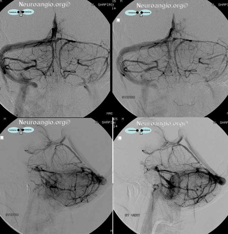 http://www.neuroangio.org/wp-content/uploads/Venous/Posterior_Fossa_Veins/V_bridging_veins_horizontal_fissure_stereo.png