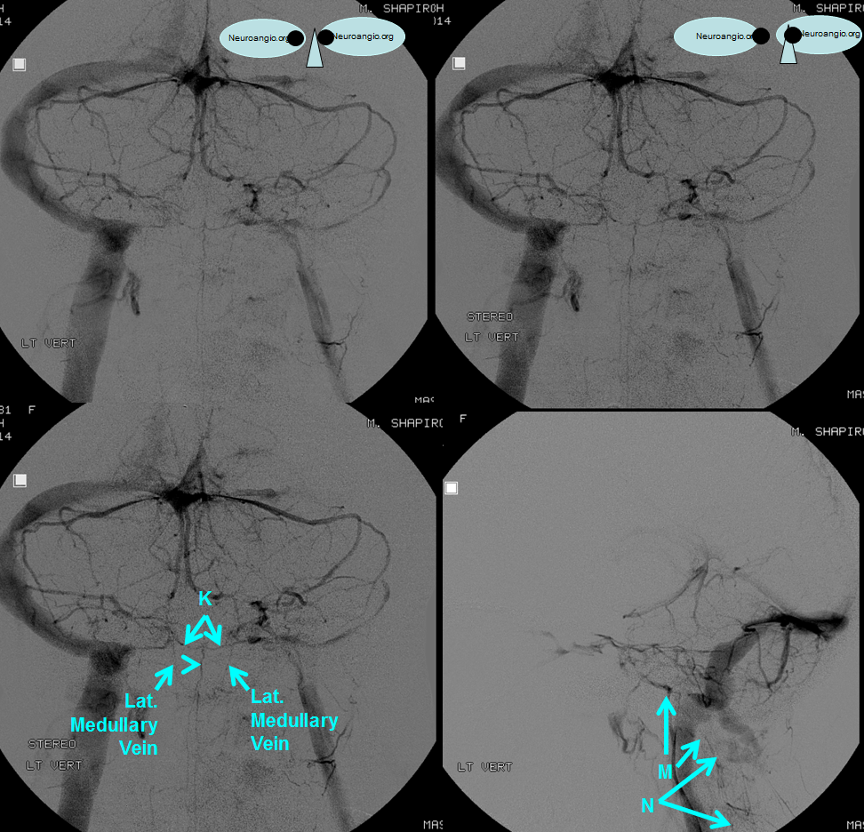 http://www.neuroangio.org/wp-content/uploads/Venous/Posterior_Fossa_Veins/V_lateral_medullary_veins.png