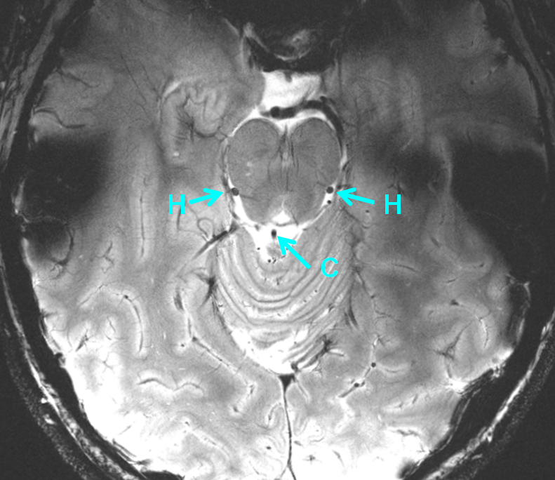 lateral_mesencephalic_vein_precentral_vein_MRI_7T.png