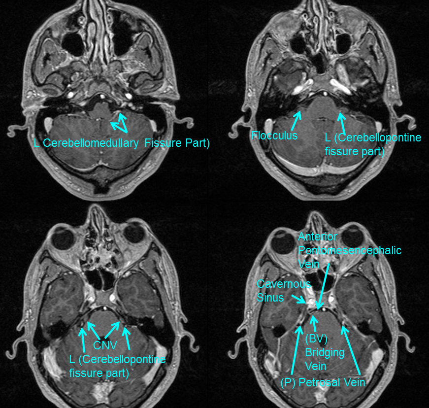 http://www.neuroangio.org/wp-content/uploads/Venous/Posterior_Fossa_Veins/V_lateral_recess_MRI.png