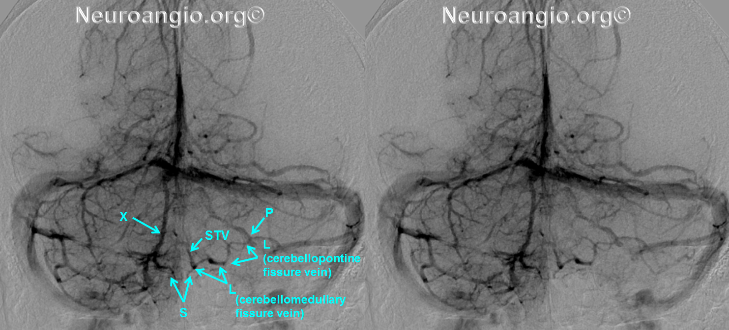 http://www.neuroangio.org/wp-content/uploads/Venous/Posterior_Fossa_Veins/V_lateral_recess_vein_tributaries.png