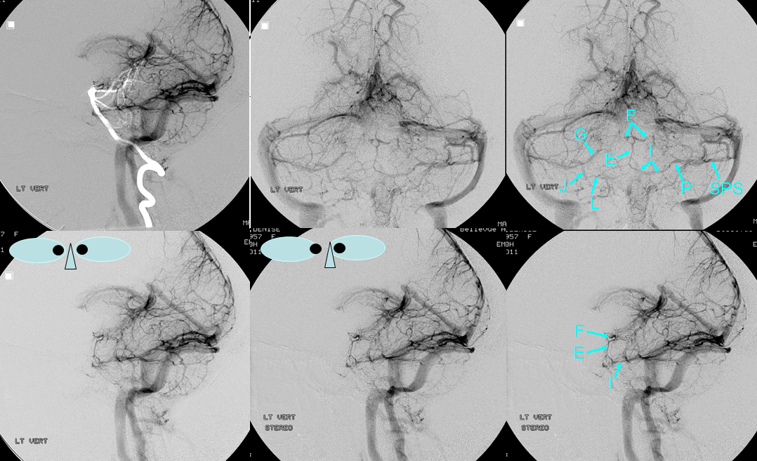 http://www.neuroangio.org/wp-content/uploads/Venous/Posterior_Fossa_Veins/V_posterior_fossa_anterior_pontomesencephalic.png