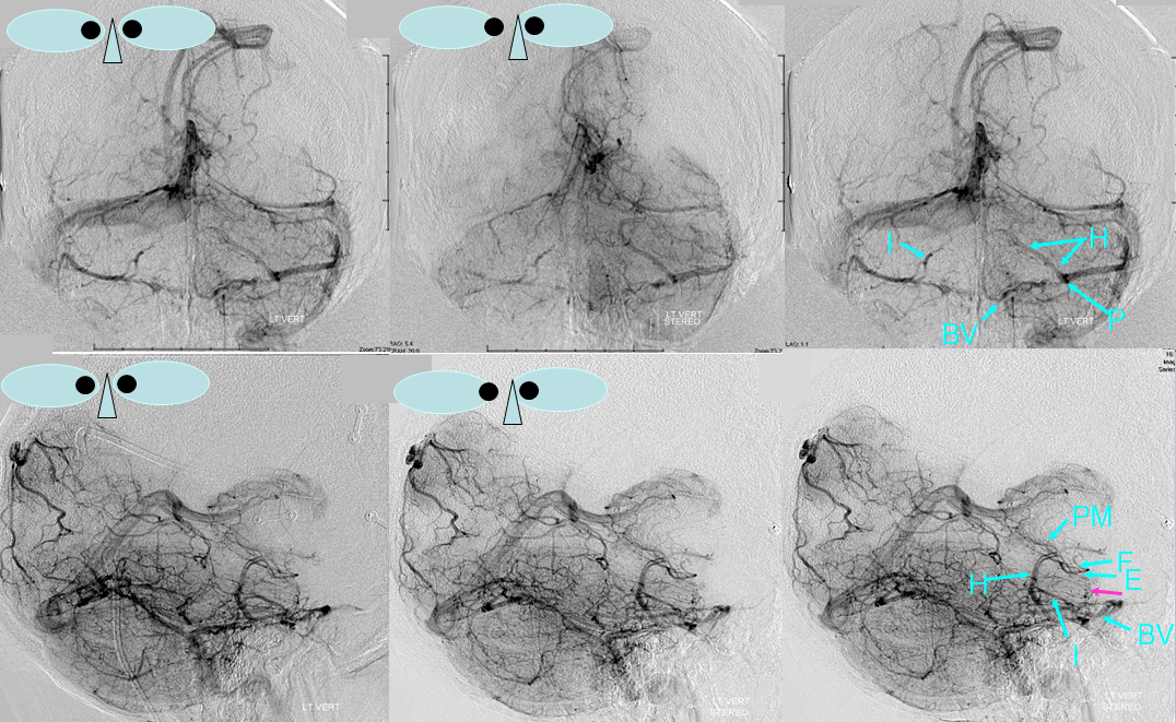 http://www.neuroangio.org/wp-content/uploads/Venous/Posterior_Fossa_Veins/V_posterior_fossa_lateral_mesencephalic_into_petrosal.png