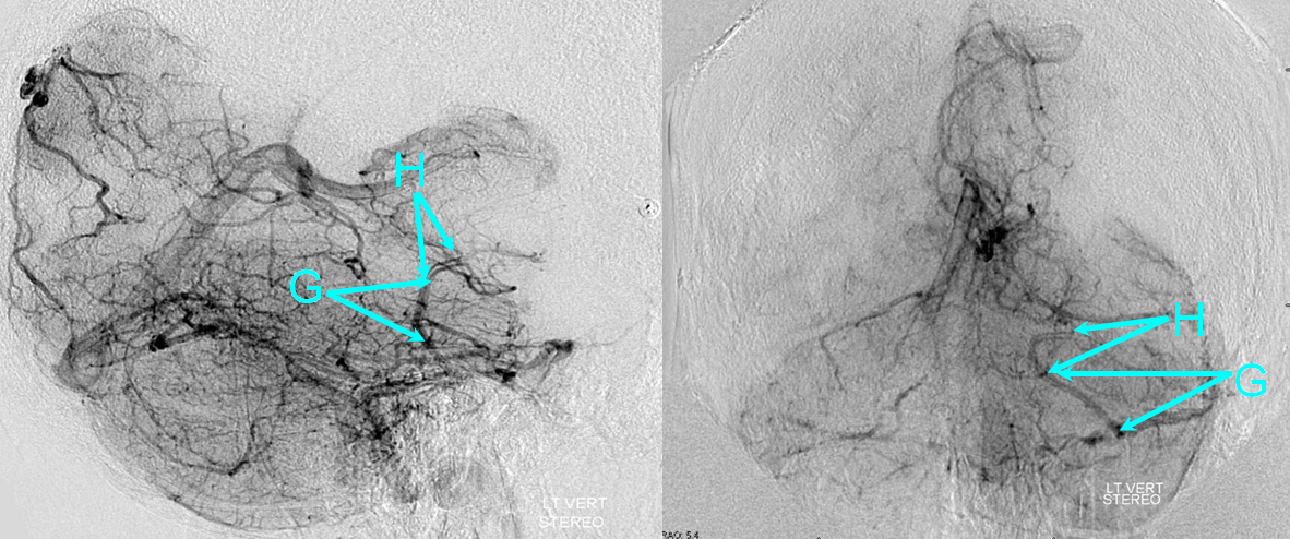 http://www.neuroangio.org/wp-content/uploads/Venous/Posterior_Fossa_Veins/V_posterior_fossa_lateral_pontomesencephalic_parts.png