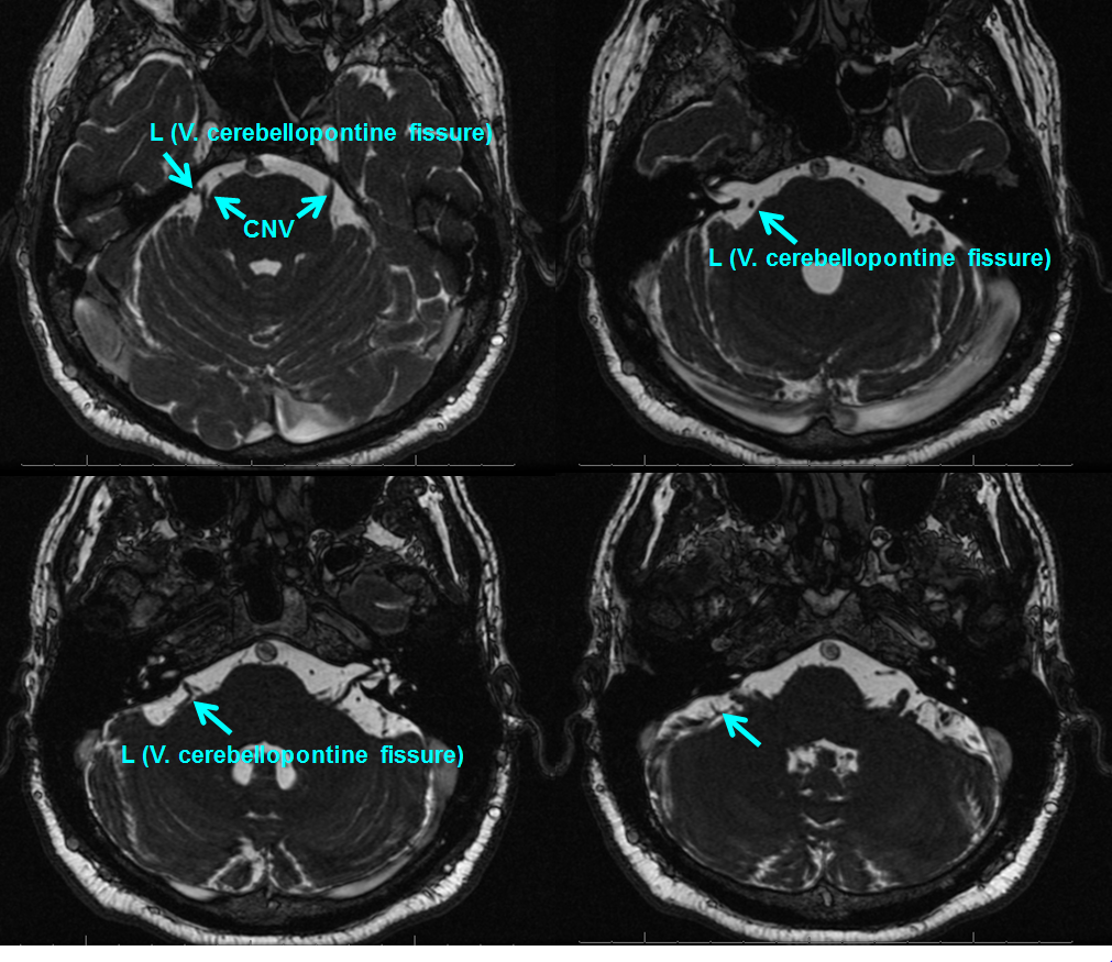 http://www.neuroangio.org/wp-content/uploads/Venous/Posterior_Fossa_Veins/V_posterior_fossa_lateral_recess_MRI_1.PNG