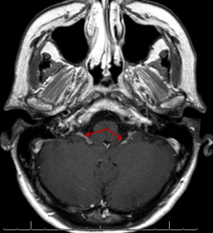 http://www.neuroangio.org/wp-content/uploads/Venous/Posterior_Fossa_Veins/V_posterior_fossa_lateral_recess_MRI_3.PNG
