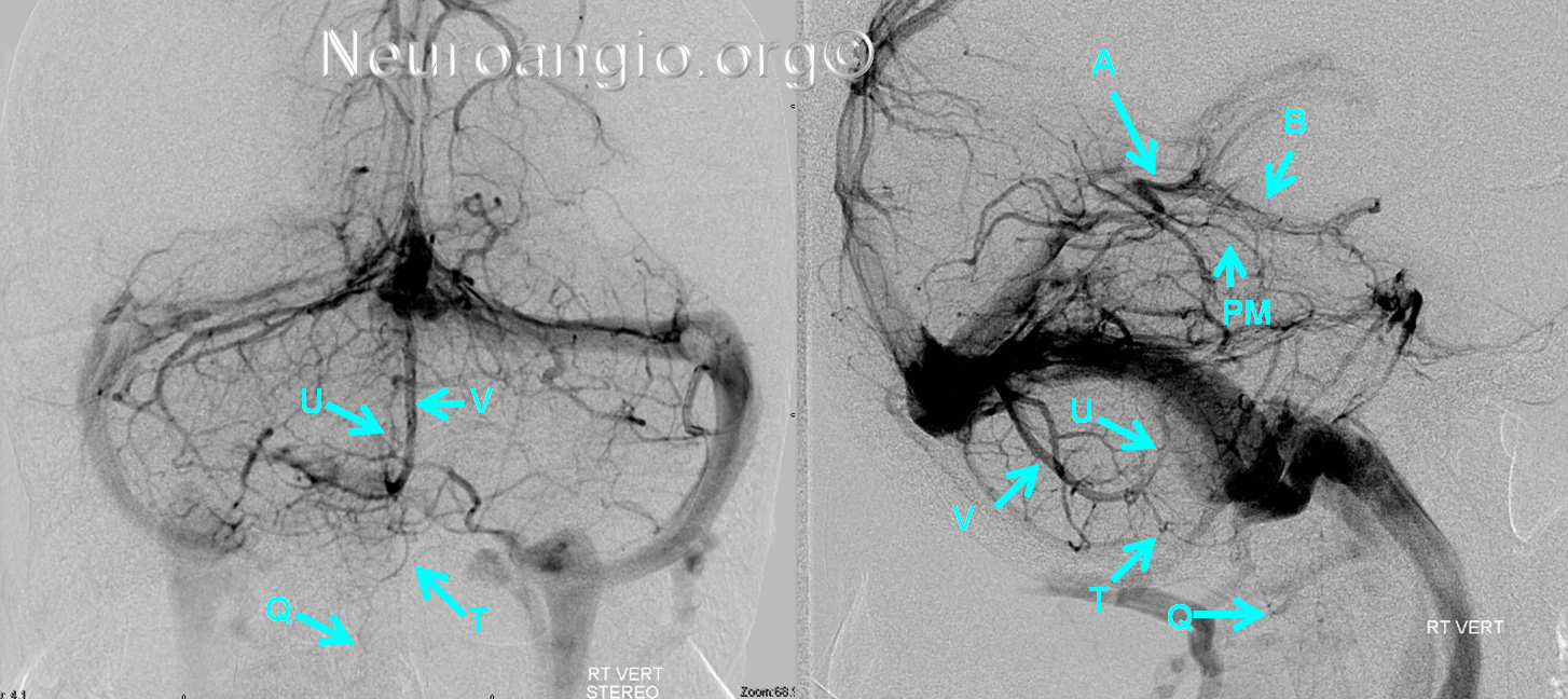 http://www.neuroangio.org/wp-content/uploads/Venous/Posterior_Fossa_Veins/V_posterior_fossa_posterior_spinal_posterior_mesencephalic_1.png