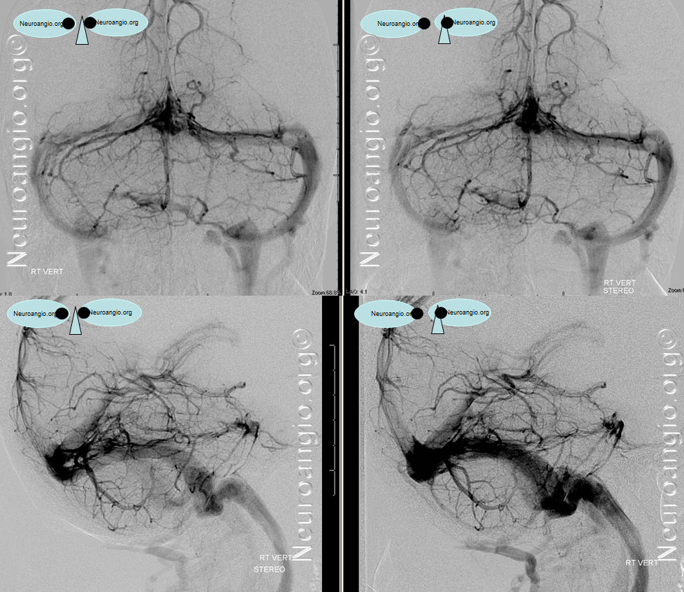 http://www.neuroangio.org/wp-content/uploads/Venous/Posterior_Fossa_Veins/V_posterior_fossa_posterior_spinal_posterior_mesencephalic_2.png