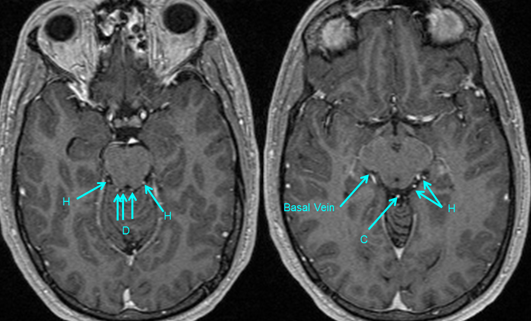 http://www.neuroangio.org/wp-content/uploads/Venous/Posterior_Fossa_Veins/V_precentral_vein_Brachial_tributaries_MRI.png