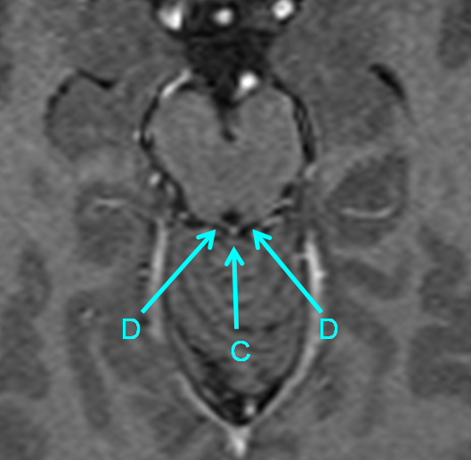 http://www.neuroangio.org/wp-content/uploads/Venous/Posterior_Fossa_Veins/V_precentral_vein_Brachial_tributaries_MRI_2.png