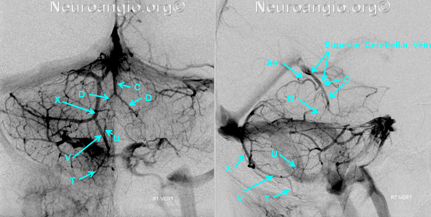 http://www.neuroangio.org/wp-content/uploads/Venous/Posterior_Fossa_Veins/V_precentral_vein_brachial_tributaries.png