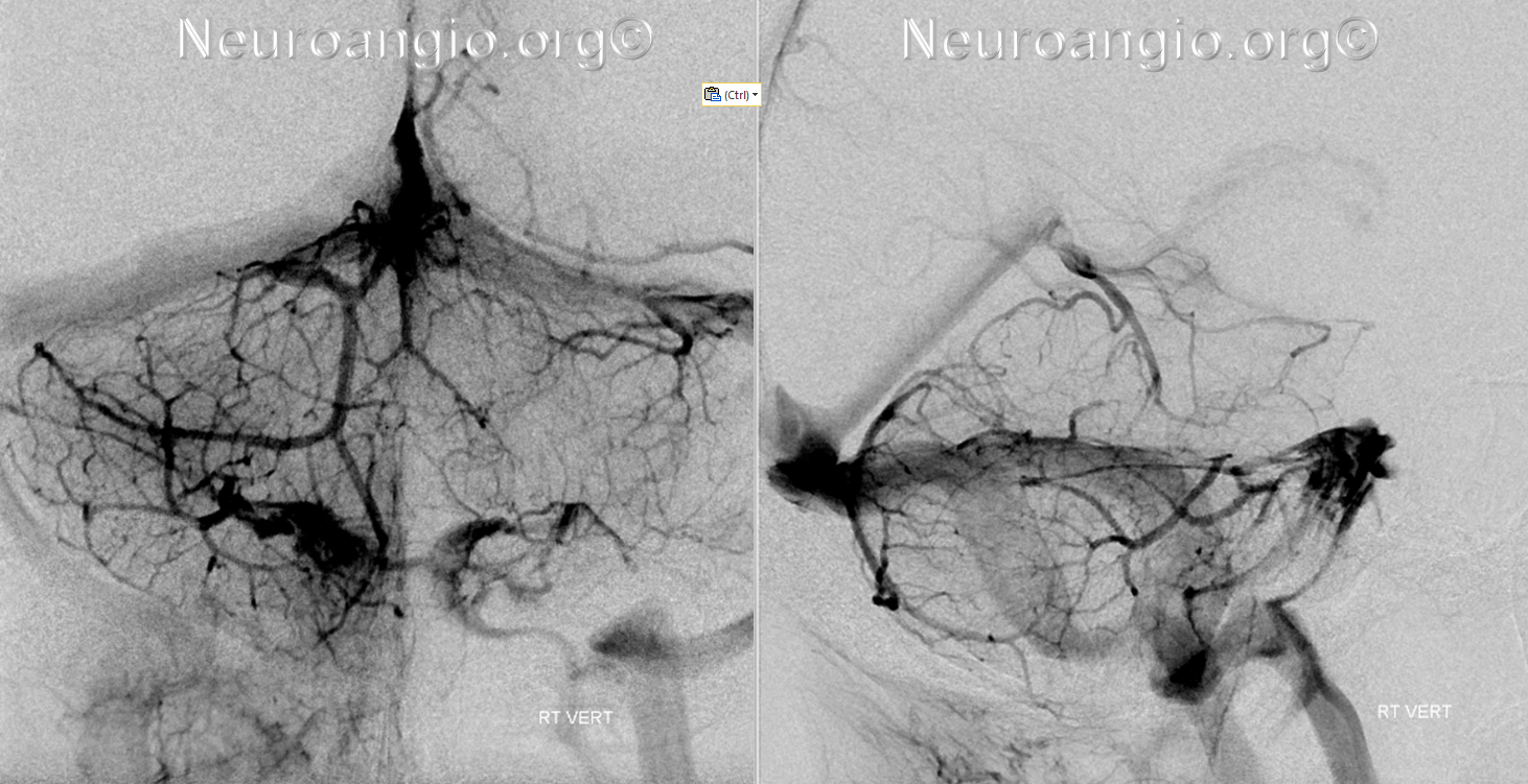 http://www.neuroangio.org/wp-content/uploads/Venous/Posterior_Fossa_Veins/V_precentral_vein_brachial_tributaries_no_labels.png