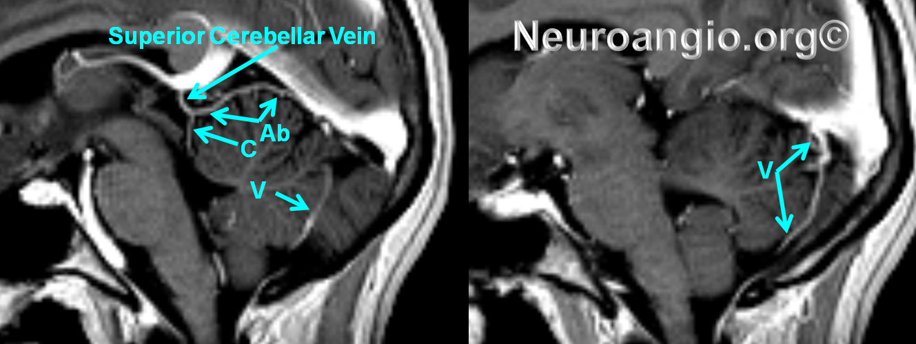 http://www.neuroangio.org/wp-content/uploads/Venous/Posterior_Fossa_Veins/V_superior_cerebellar_vein.png