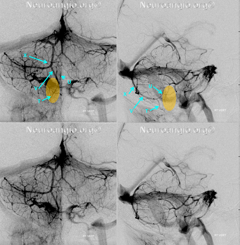 http://www.neuroangio.org/wp-content/uploads/Venous/Posterior_Fossa_Veins/V_tonsil.png