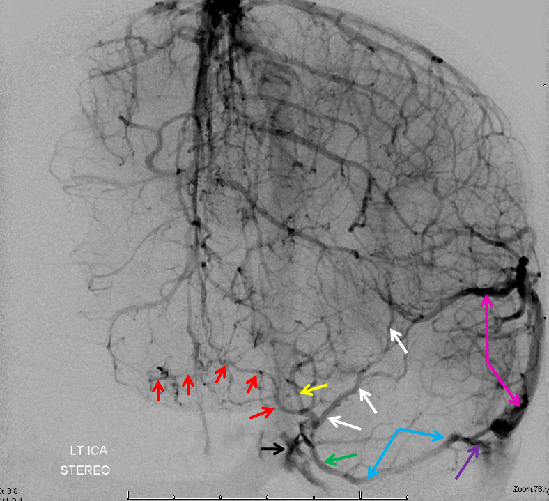 anterior cerebral vein