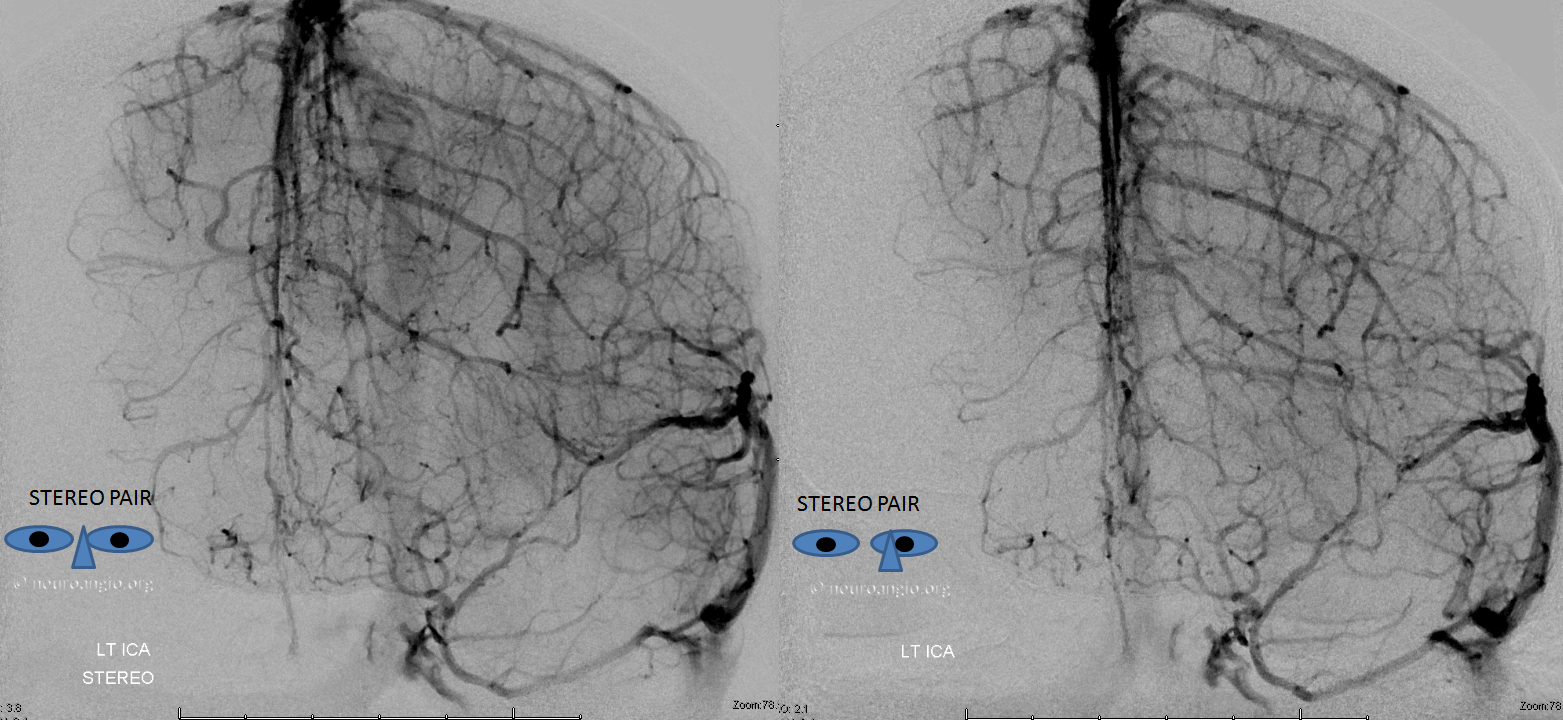 anterior cerebral vein