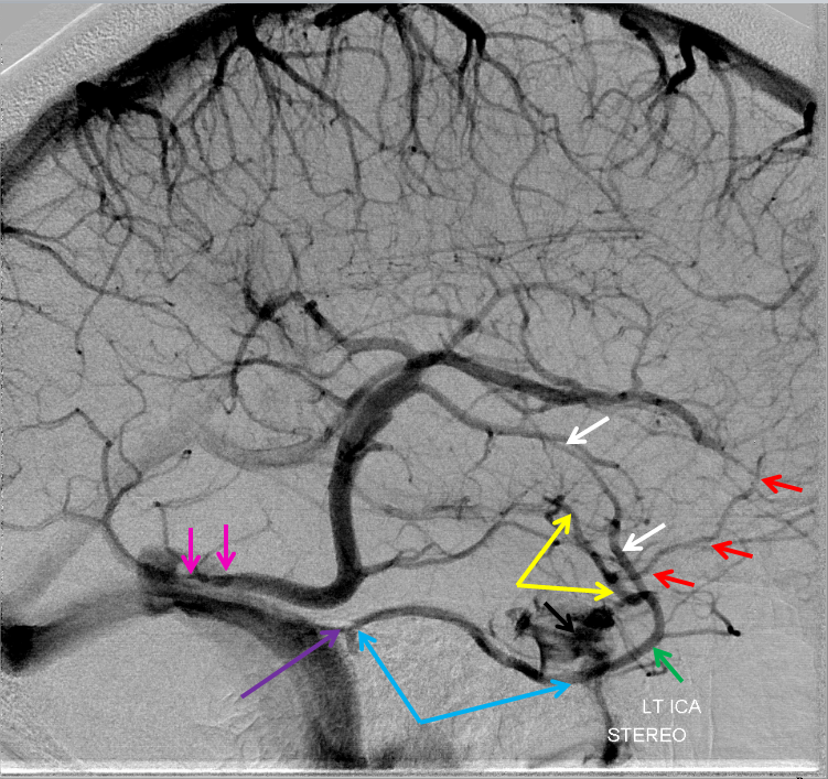 cortical venous narrowing near sinus entry