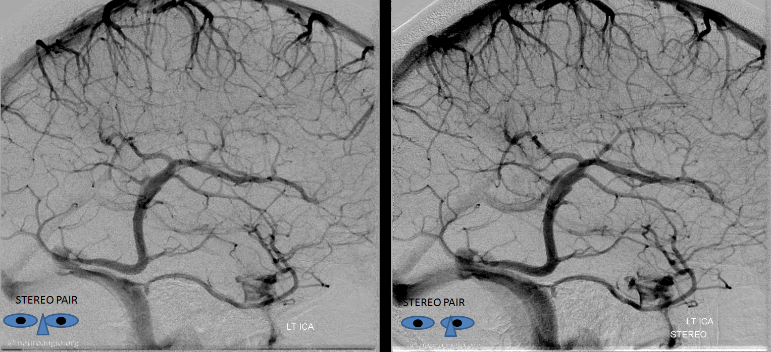 anterior cerebral vein