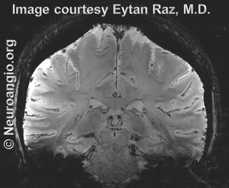 http://www.neuroangio.org/wp-content/uploads/Venous/V_7T_MRI_transmedullary_veins_1.png