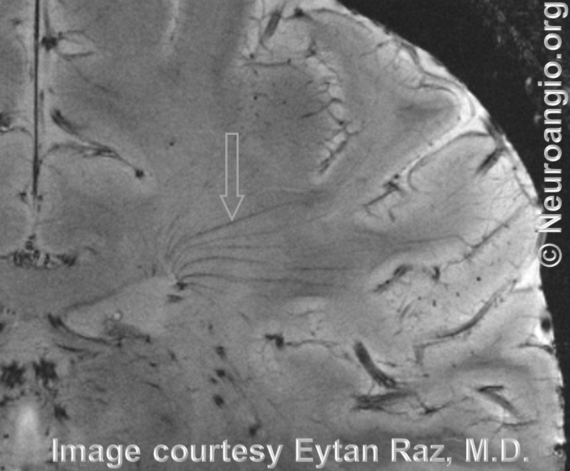 Transmedullary veins MRI 7T