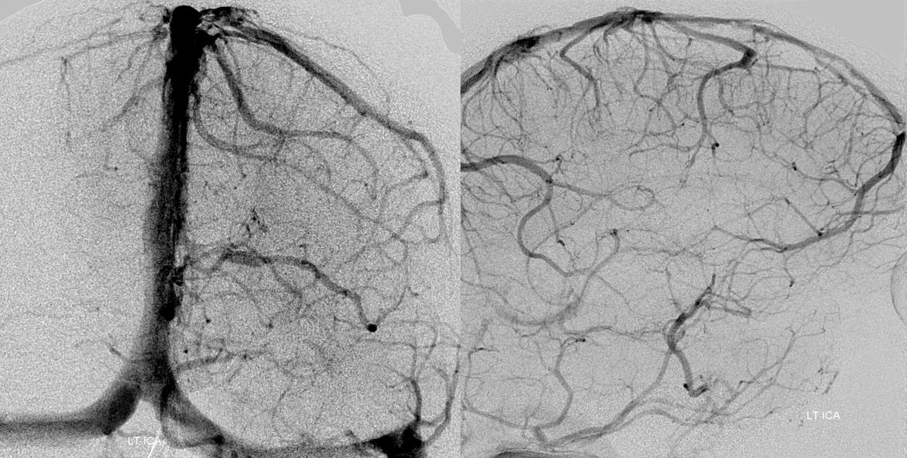 ICA injection, no ophthalmic vein visualized