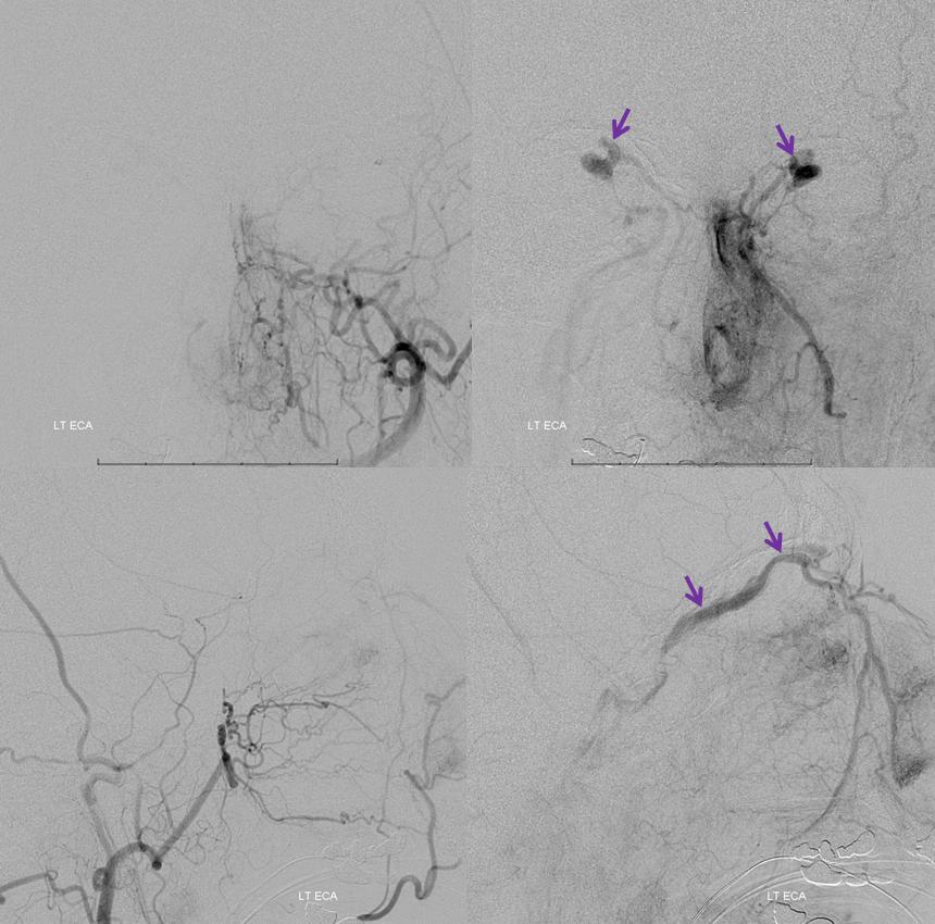 ECA injection, same side, ophthalmic veins well seen