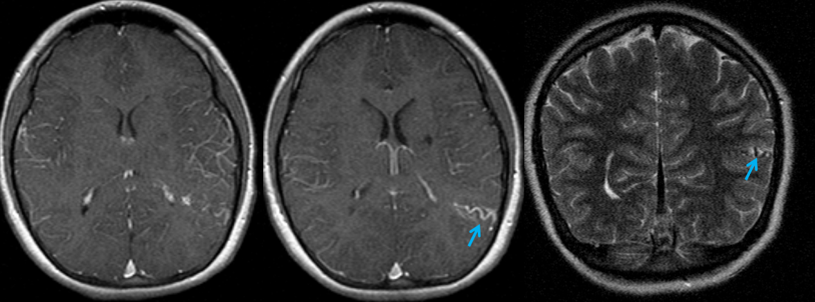 http://www.neuroangio.org/wp-content/uploads/Venous/V_DVA_AVM_mimic_1.png http://www.neuroangio.org/wp-content/uploads/Venous/V_DVA_AVM_mimic_1.png
