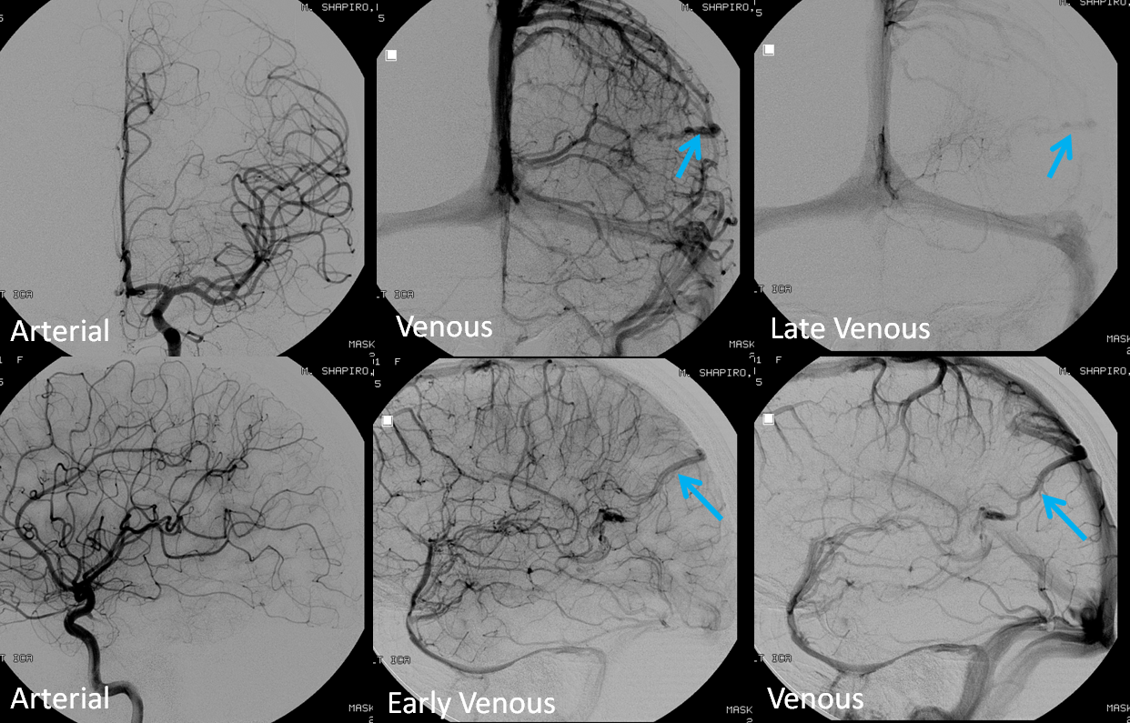 http://www.neuroangio.org/wp-content/uploads/Venous/V_DVA_AVM_mimic_3.png http://www.neuroangio.org/wp-content/uploads/Venous/V_DVA_AVM_mimic_3.png