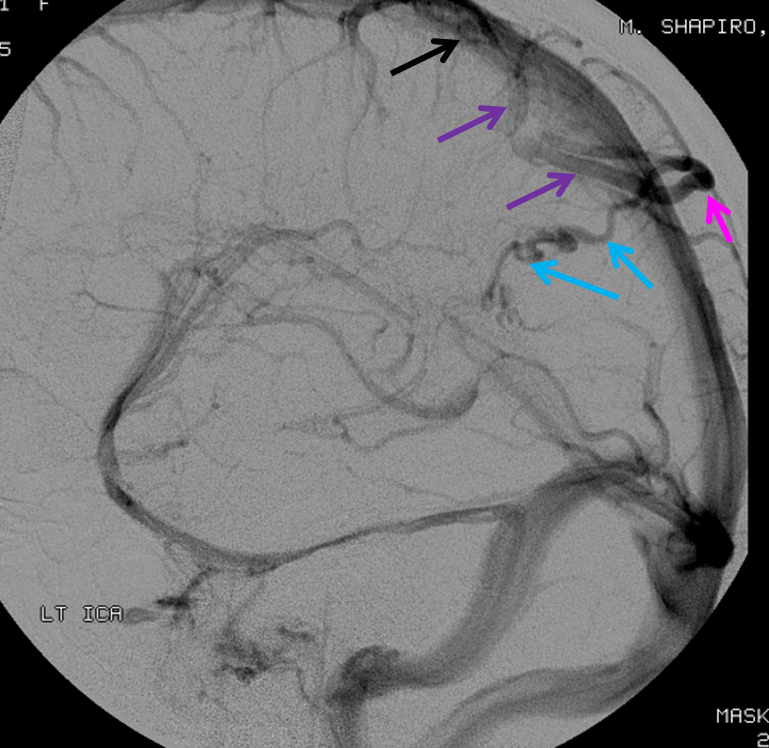 http://www.neuroangio.org/wp-content/uploads/Venous/V_DVA_AVM_mimic_5.png