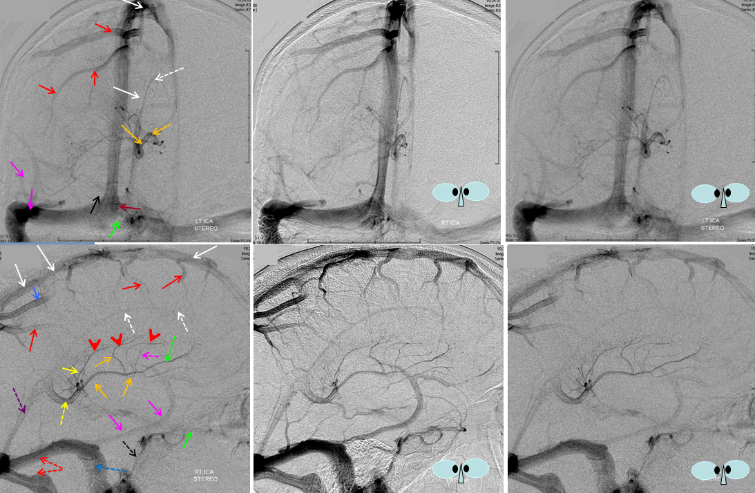Superior cerebral veins - Wikipedia