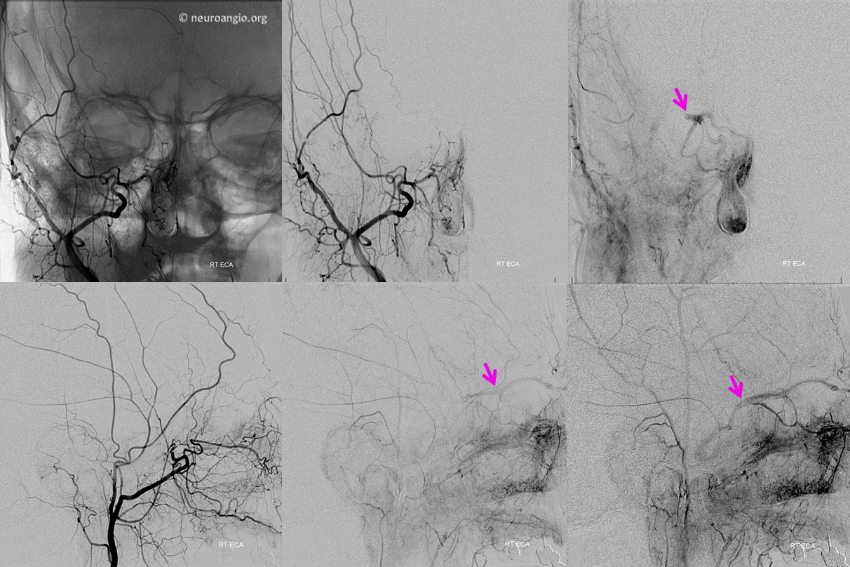 superior ophthalmic vein