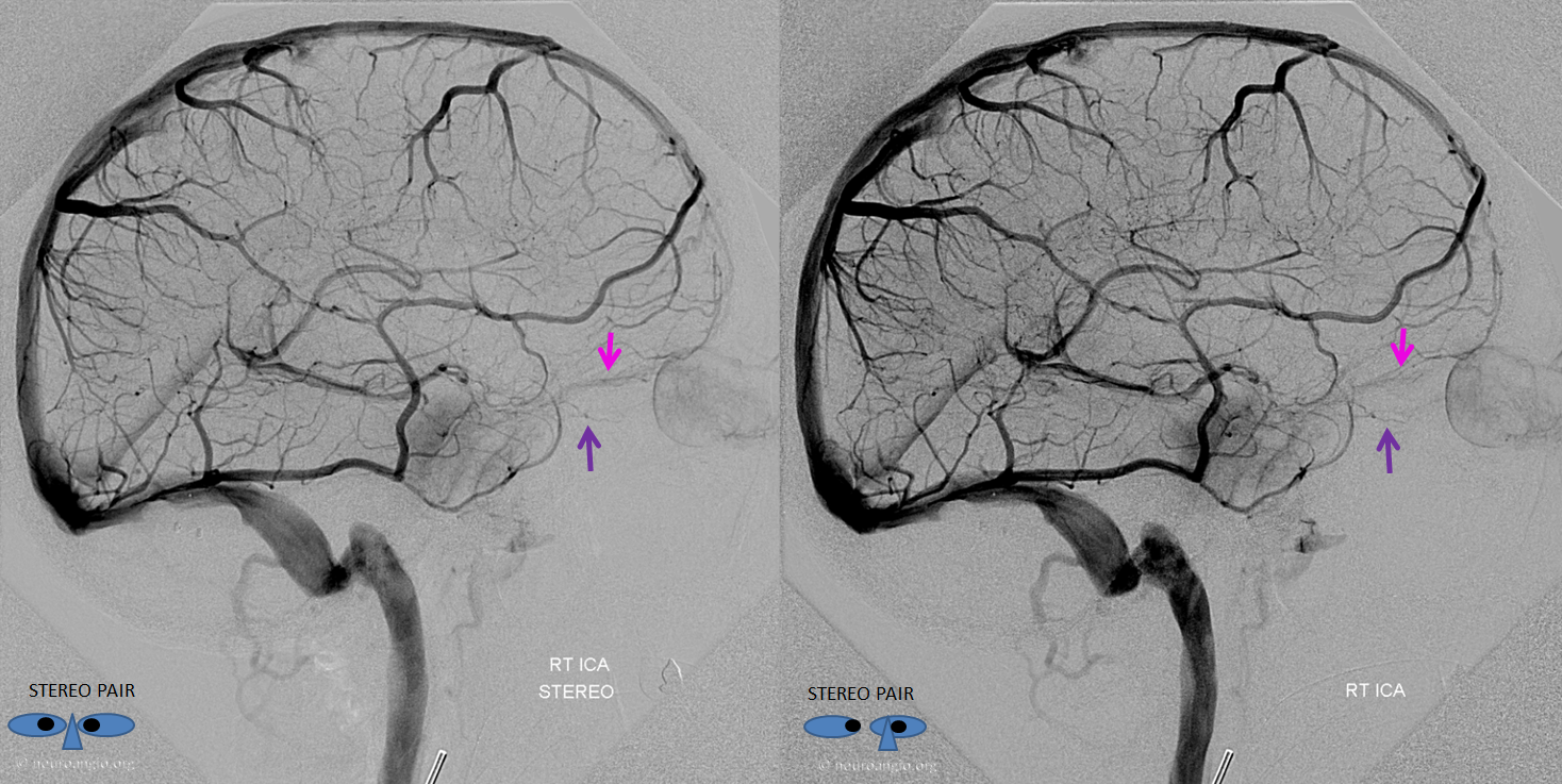 http://www.neuroangio.org/wp-content/uploads/Venous/V_SOV_IOV_ICA_Injection.png