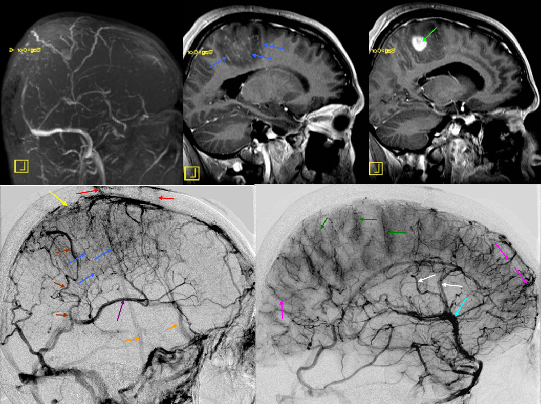 SSS thrombosis transmedullary veins