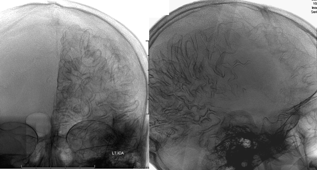 LT Temporal hematoma angio stereo