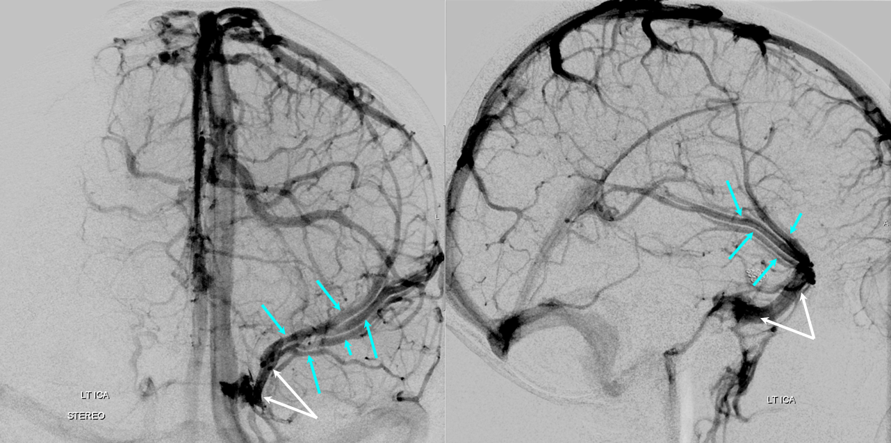 Superficial Sylvian Veins