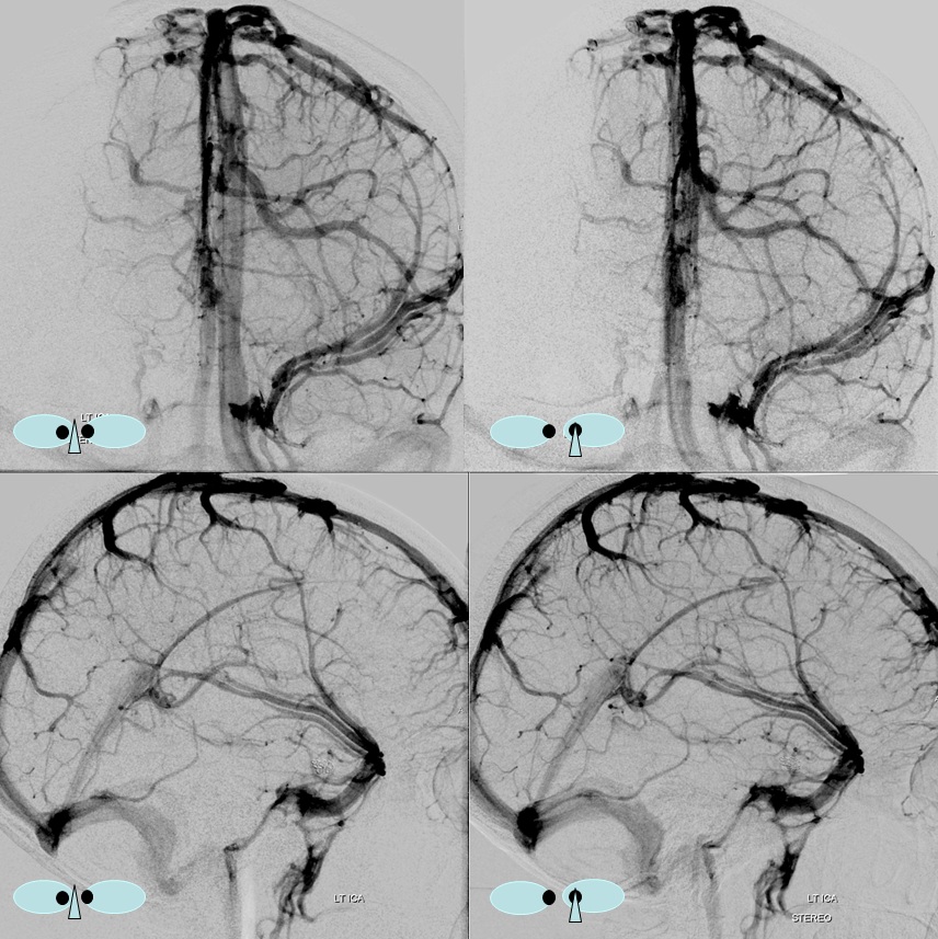 Superficial Sylvian Veins