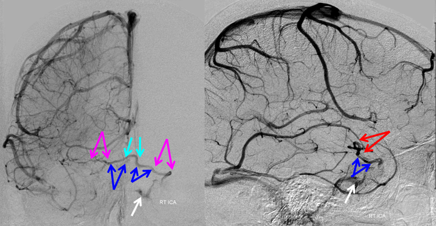 http://www.neuroangio.org/wp-content/uploads/Venous/V_anterior_cerebral_vein.png