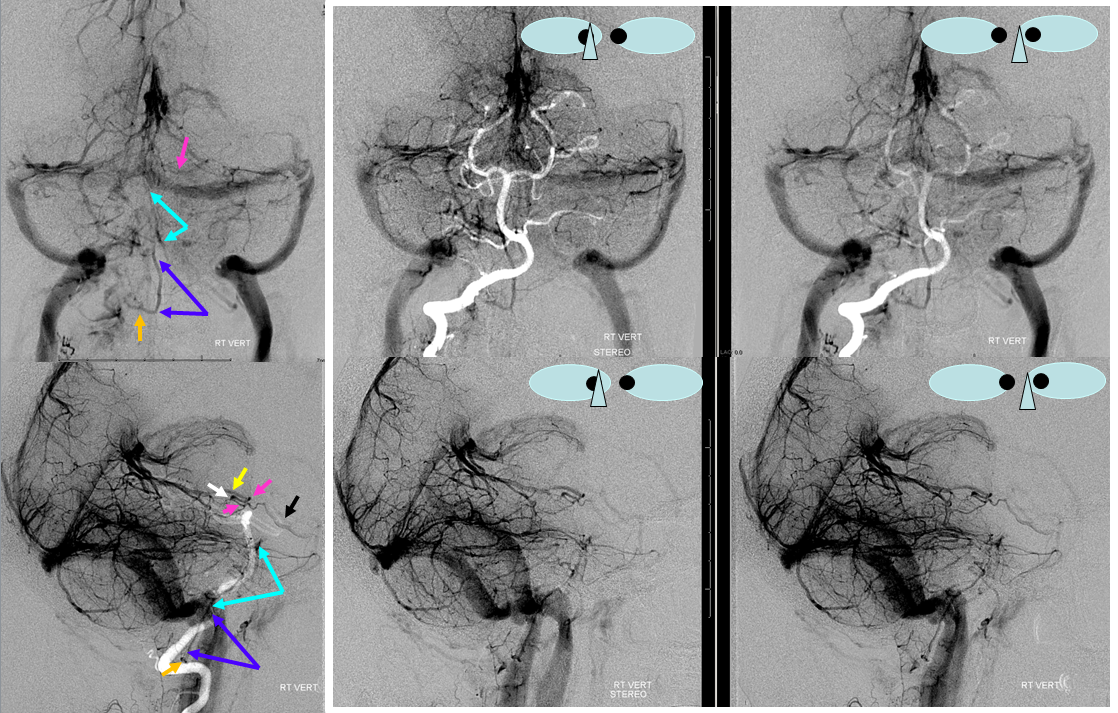 http://www.neuroangio.org/wp-content/uploads/Venous/V_anterior_pontomedullary_vein_and_bridging_vein.png