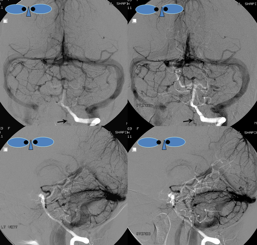 http://www.neuroangio.org/wp-content/uploads/Venous/V_anterior_pontomescencephalic_vein_stereo_NO_abels.png