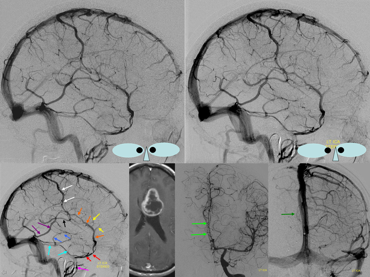 The larger superficial cerebral veins, including those draining the