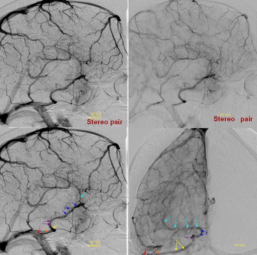 http://www.neuroangio.org/wp-content/uploads/Venous/V_basal_vein_to_petrosal_sinus_via_lateral_mesencephalic_angio.jpg