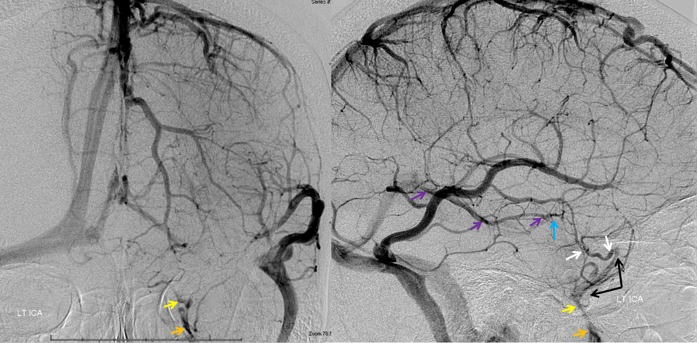 http://www.neuroangio.org/wp-content/uploads/Venous/V_cavernous_sinus_angiogram_LT_ICA.png